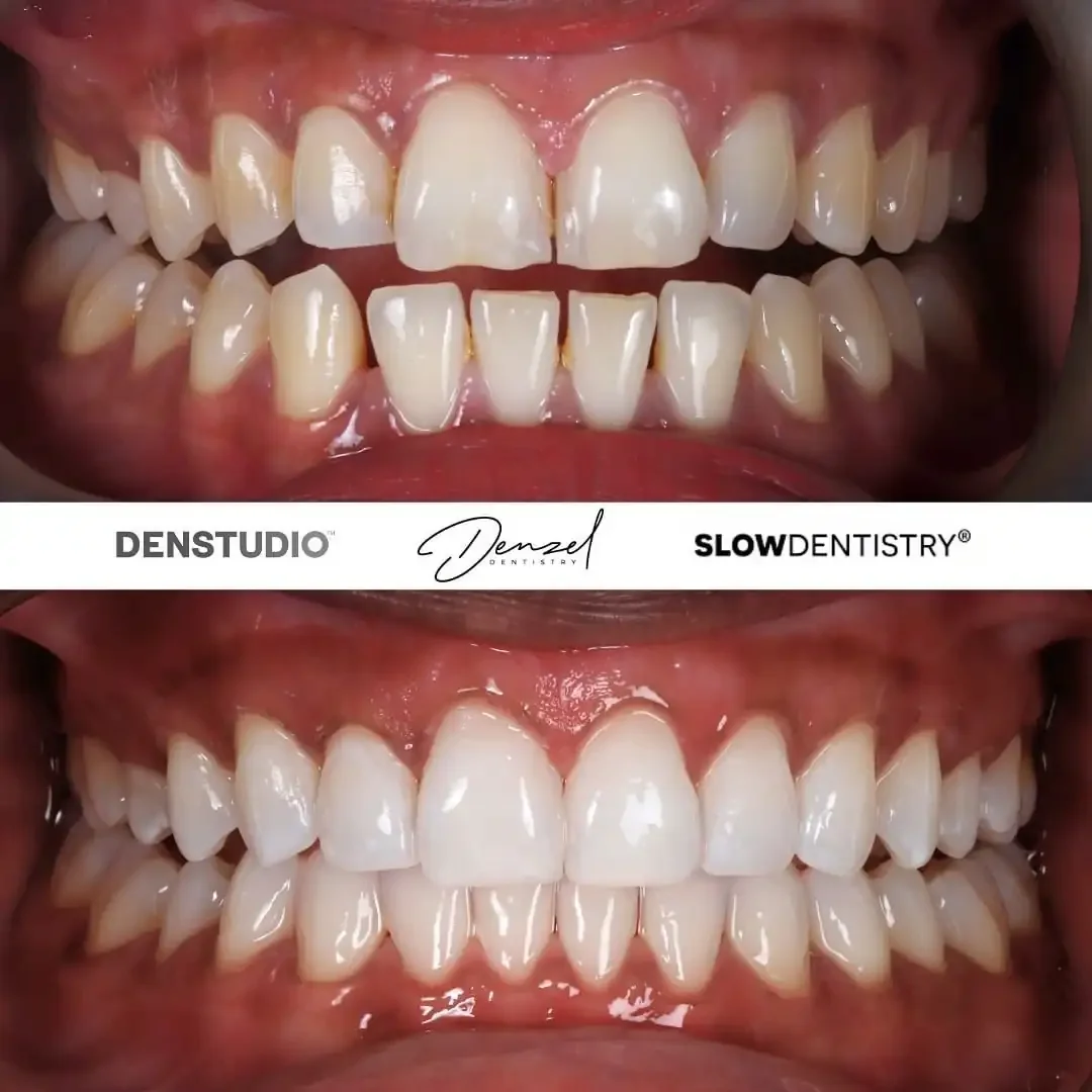 Invisalign before and after 2
