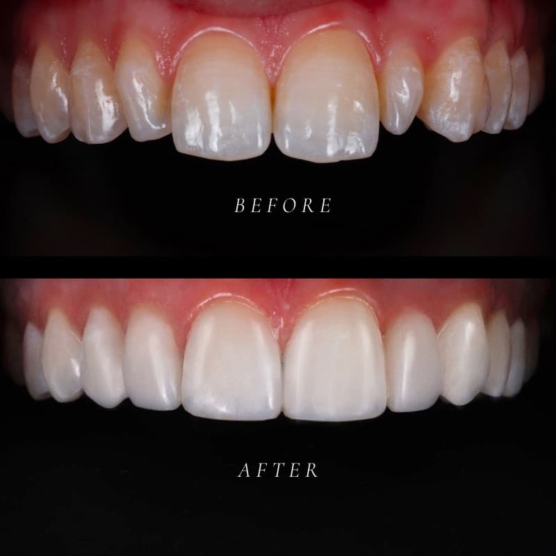 Composite bonding transformation — before and after