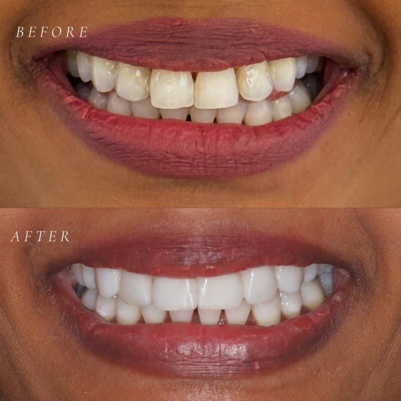 Smile makeover with bonding — before and after