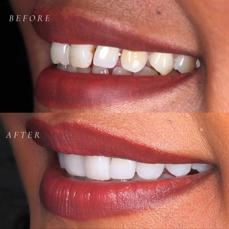 Composite bonding — before and after