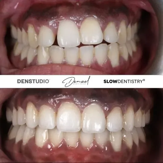 Composite bonding — before and after