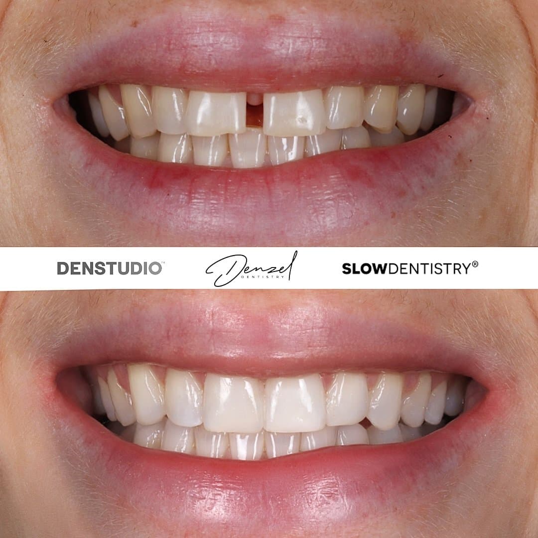Smile transformation result