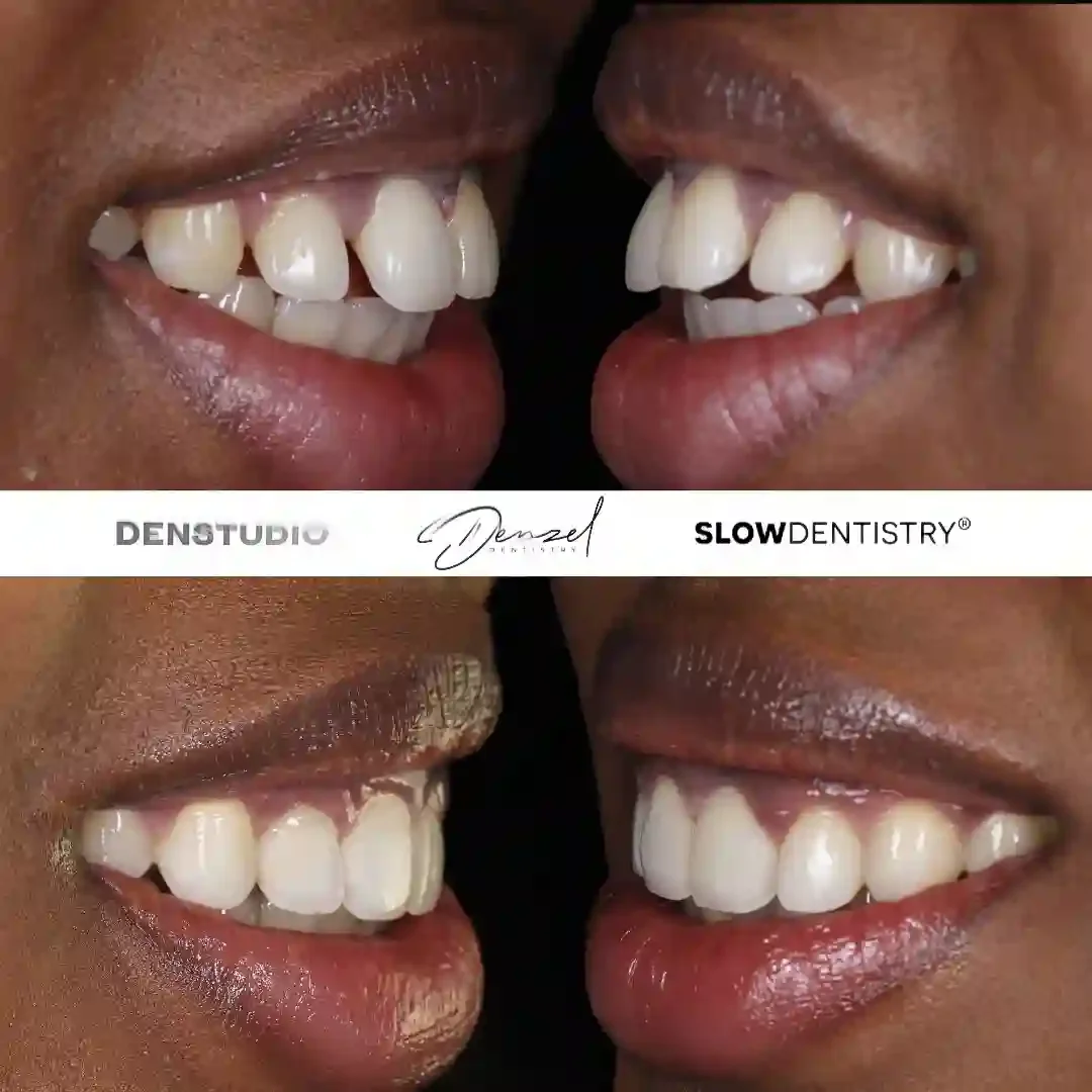Composite bonding patient result 6