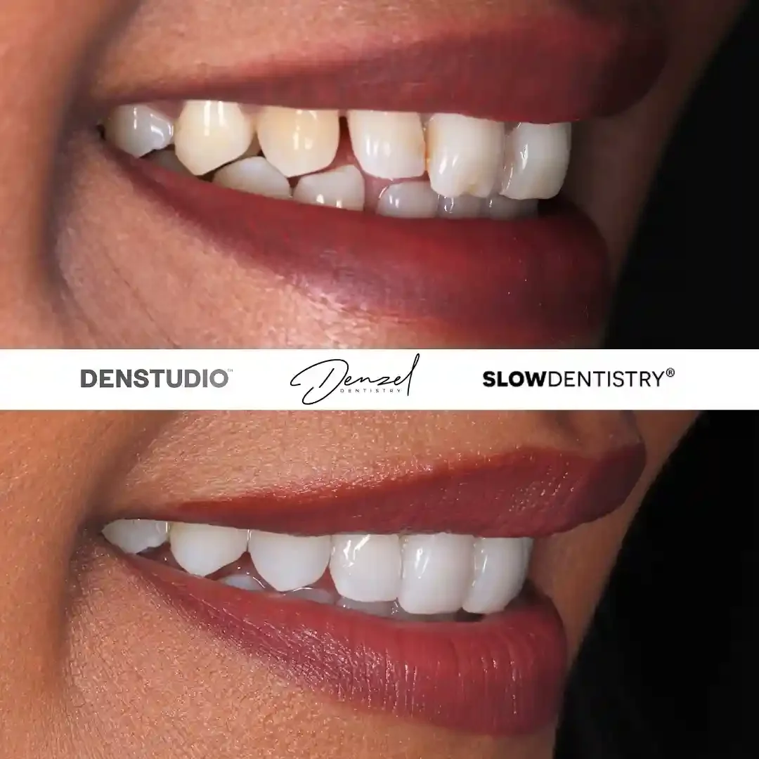 Invisalign and bonding result
