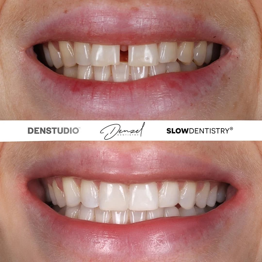 Composite bonding and Invisalign result