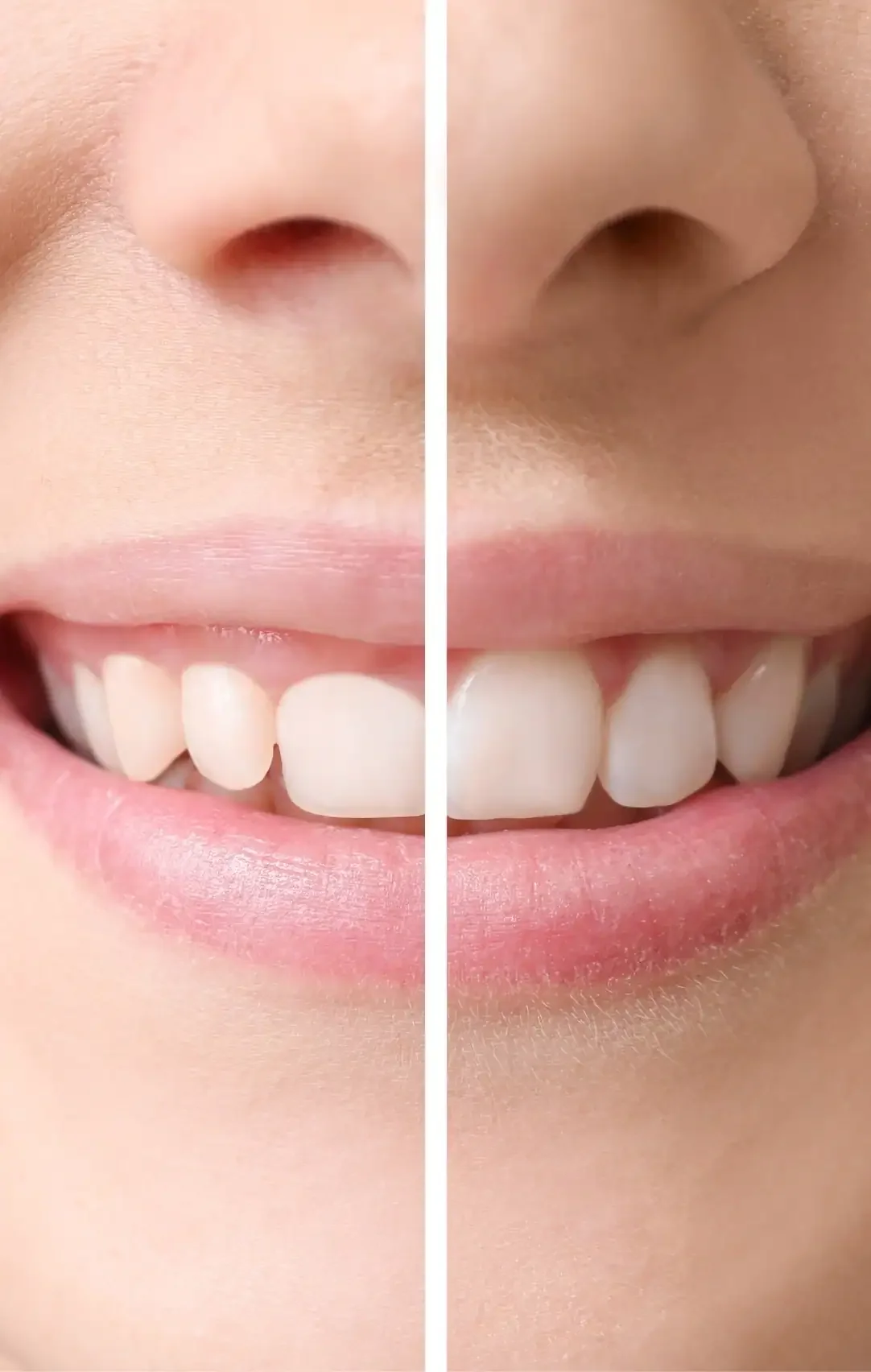 Types of Gummy Smiles