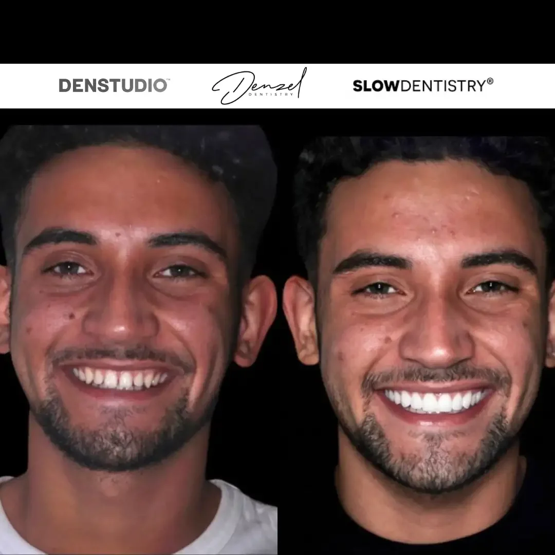 Smile makeover with porcelain veneers — before and after