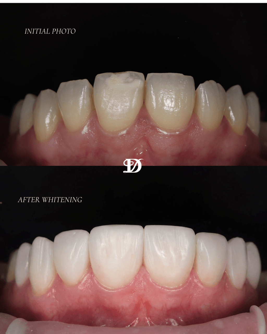 Teeth whitening transformation, before and after