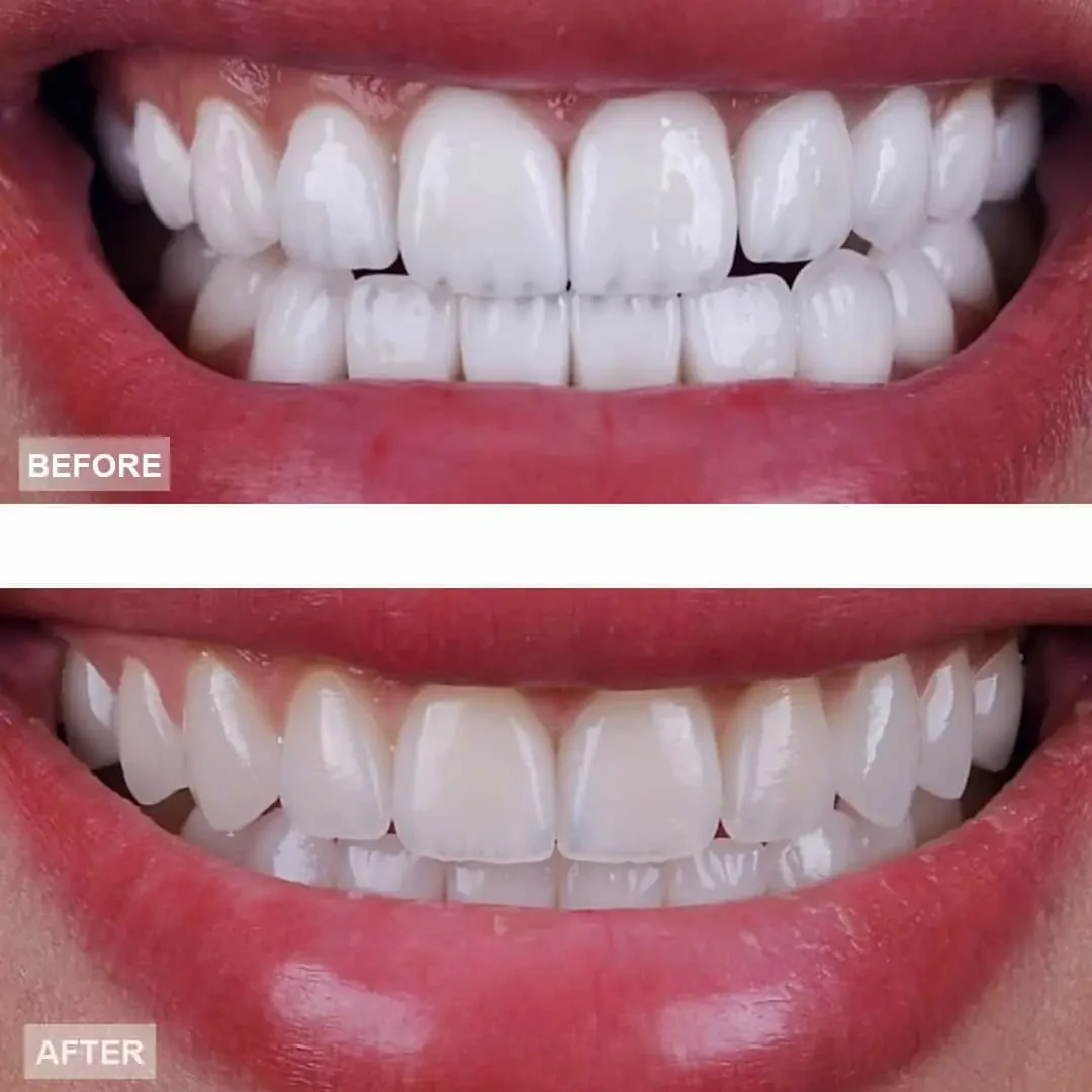 Teeth whitening transformation — before and after
