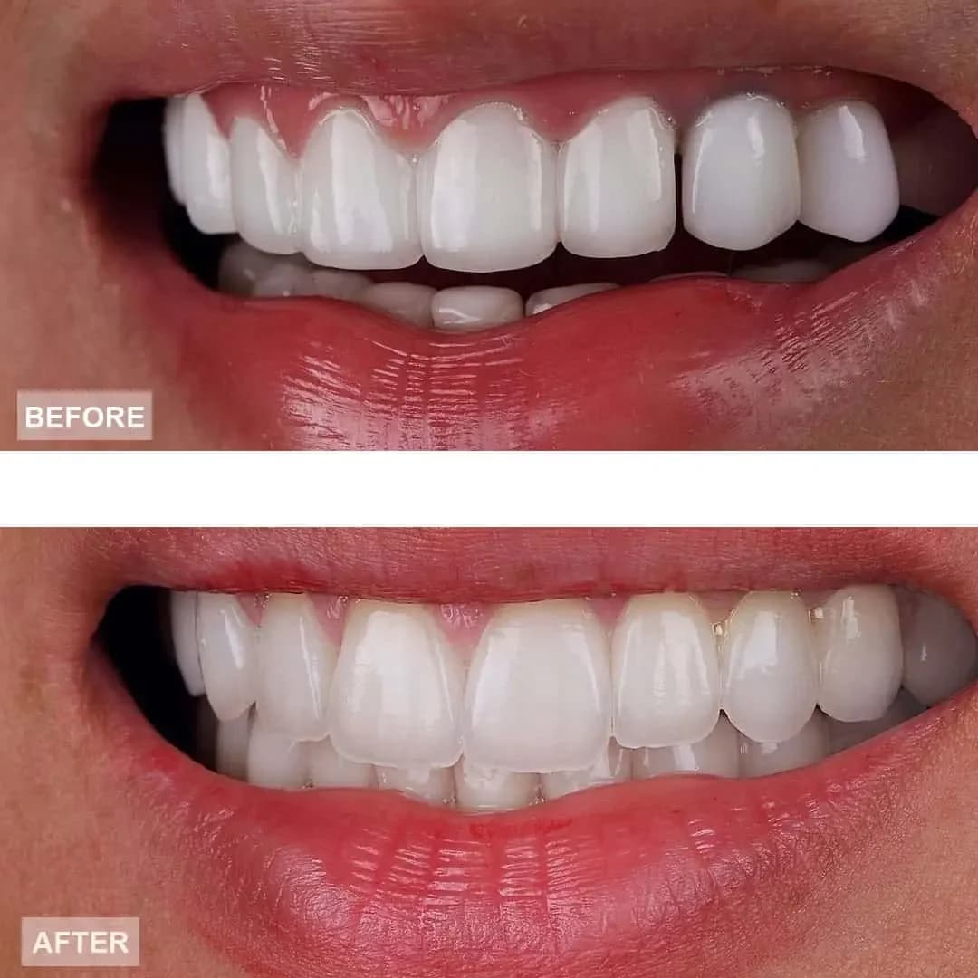 Teeth straightening — before and after