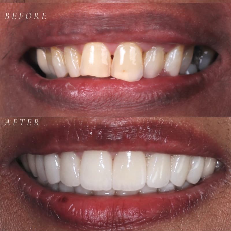 Porcelain veneers clinical result — before and after