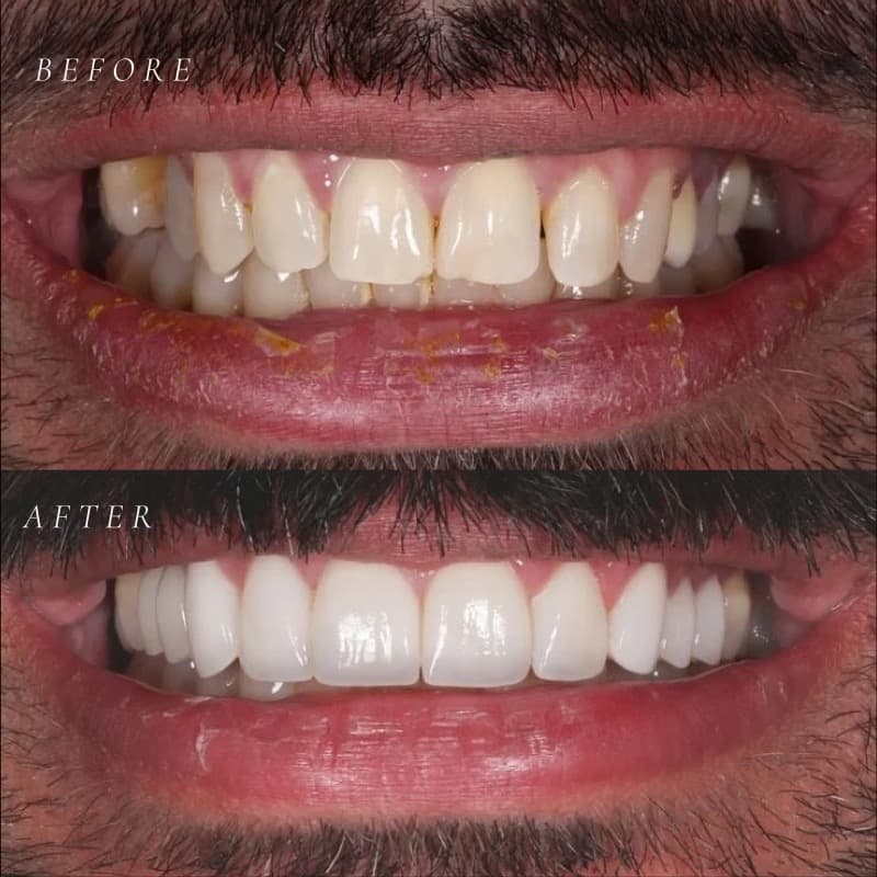 Smile makeover — before and after