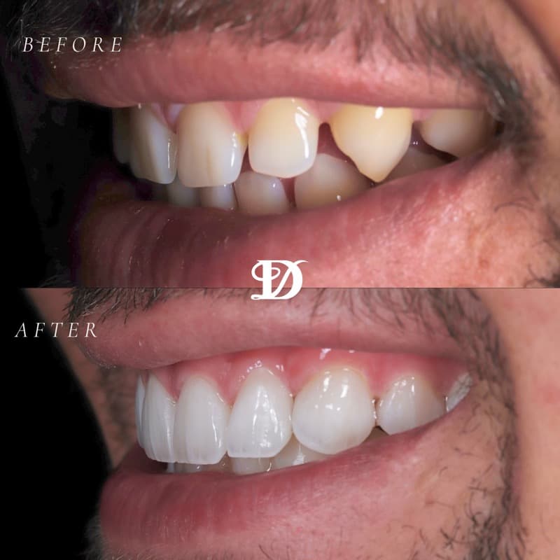 Porcelain veneers transformation — before and after